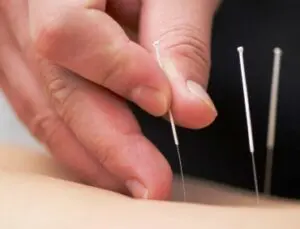 acupuncture