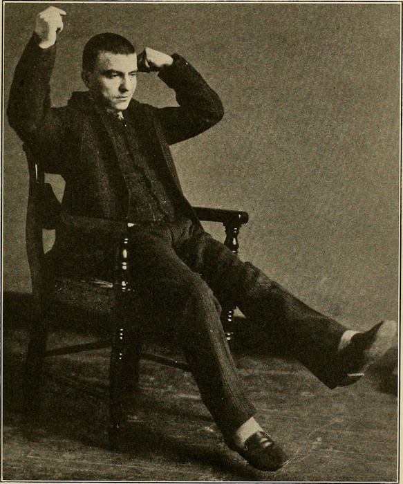 A cataleptic patient, from a 1915 medical guide
